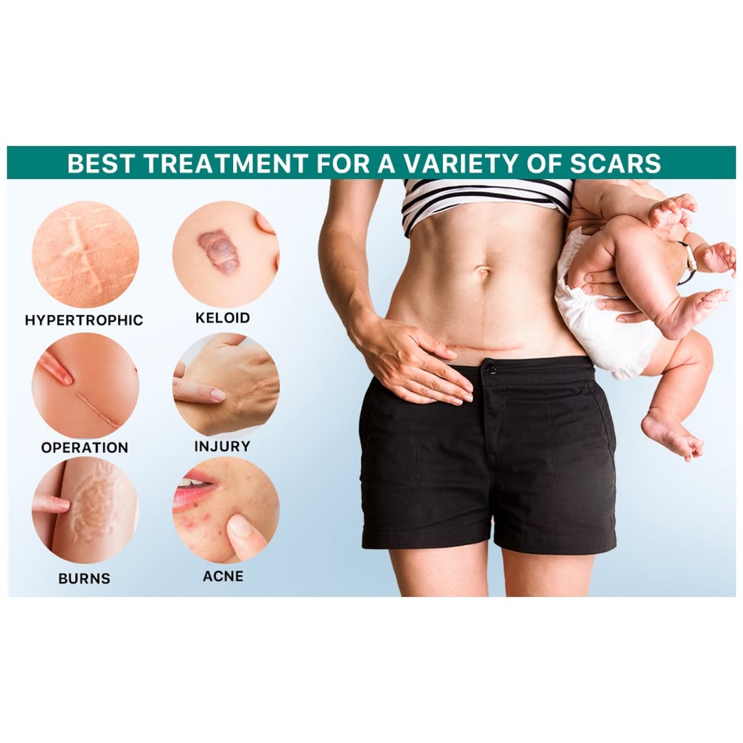 Chemical-Free Scar Remover Tape